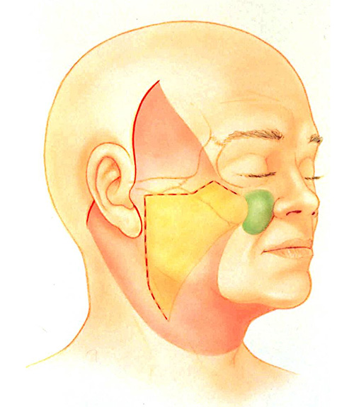 Extended SMAS Facelift Technique Infographic