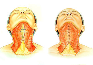 Neck Lift Infographic