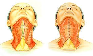 Neck Lift Infographic