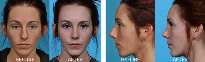 Dr. Afrooz - Rhinoplasty Before and After
