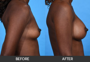 Breast Augmentation Before & After - Dr. Afrooz, Miami, FL