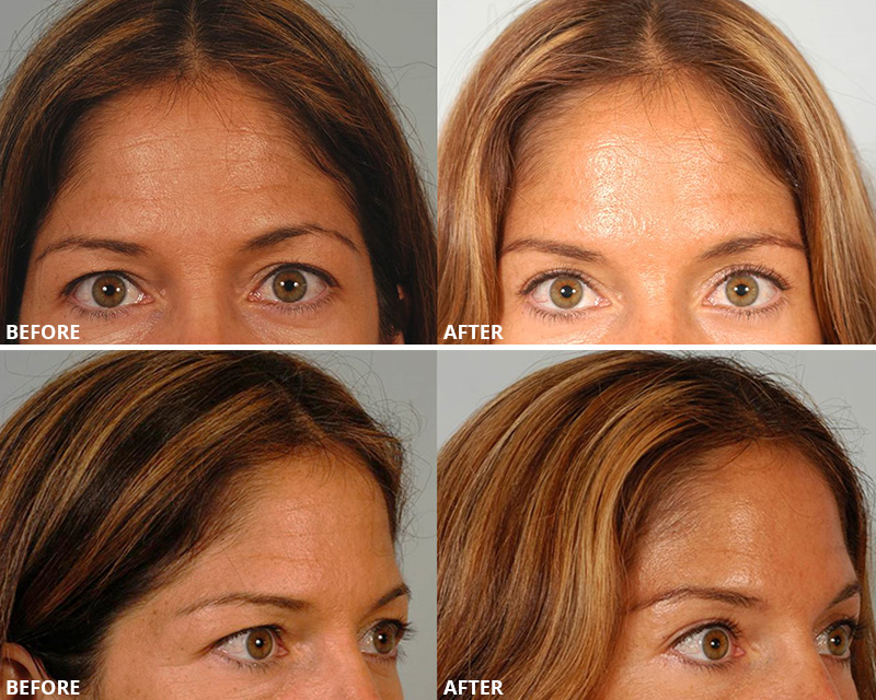 Dr. Stuzin Brow Lift Before & After