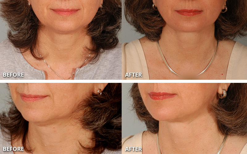 Dr. Stuzin Facelift Before & After