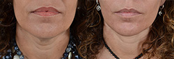 Before and after facelift