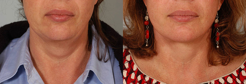 Dr. Stuzin Facelift Before & After