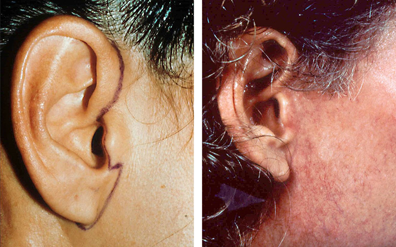 Dr. Stuzin Facelift Before & After