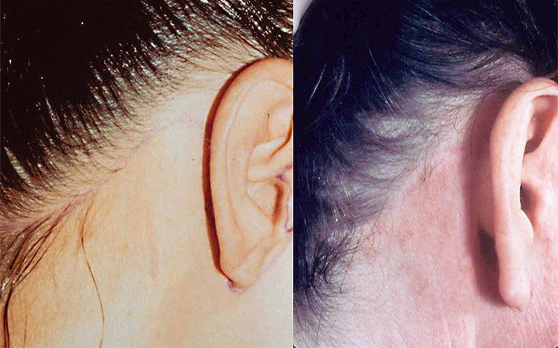 Dr. Stuzin Facelift Before & After