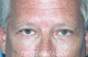 Eyelid Surgery for Men Before and After