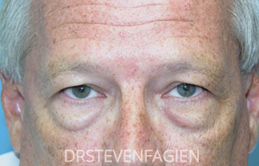Eyelid Surgery for Men Before and After