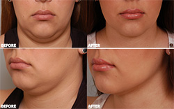 Before and after neck lift