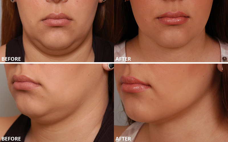 Dr. Stuzin Neck Lift Before & After