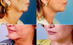 Before and after neck lift