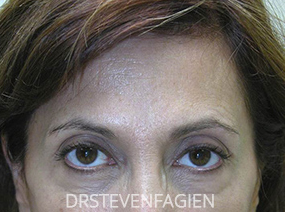 Non Surgical Eye Enhancement Before and After