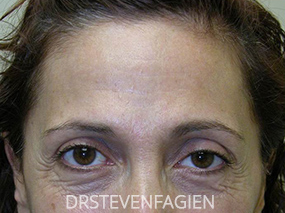Non Surgical Eye Enhancement Before and After
