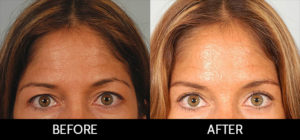 Brow Lift Before and After, Miami, FL