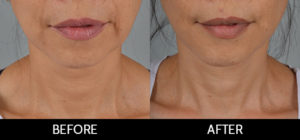 Facelift Before and After, Miami, FL