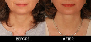 Facelift Before and After, Miami, FL