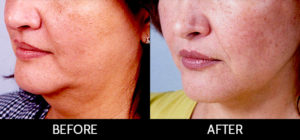 Neck Lift Before and After, Miami, FL