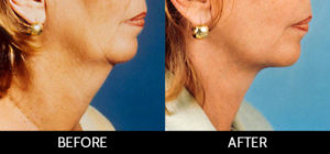 Neck Lift Before and After, Miami, FL