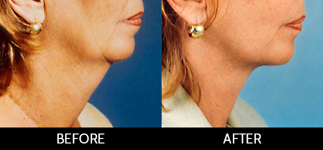 Neck Lift Gallery