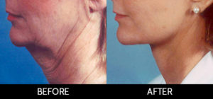 Neck Lift Before and After, Miami, FL