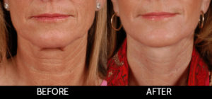 Facelift Before and After, Miami, FL