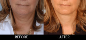 Facelift Before and After, Miami, FL