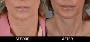 Facelift Before and After, Miami, FL