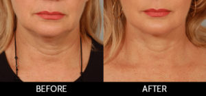 Facelift Before and After, Miami, FL