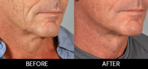 Facelift Before and After, Miami, FL