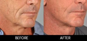 Facelift Before and After, Miami, FL