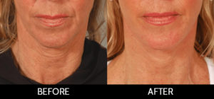 Facelift Before and After, Miami, FL