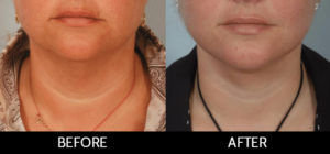 Facelift Before and After, Miami, FL