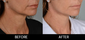 Facelift Before and After, Miami, FL