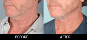 Facelift Before and After, Miami, FL