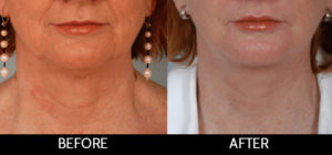 Facelift Before and After, Miami, FL