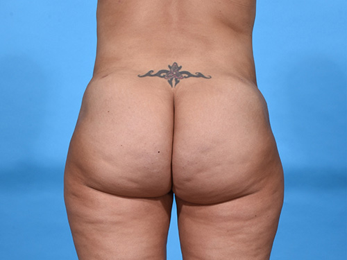Brazilian Butt Lift After Brazilian Butt Lift After - Miami, FL