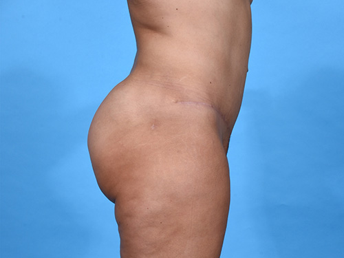 Brazilian Butt Lift After Brazilian Butt Lift After - Miami, FL