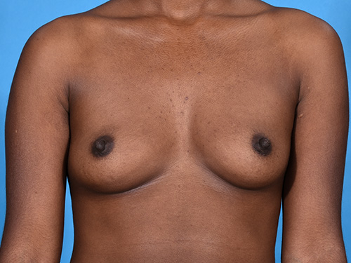 Breast Augmentation Before - Miami, FL