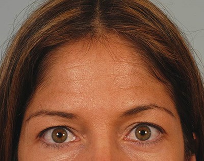 Facelift Before - Miami, FL