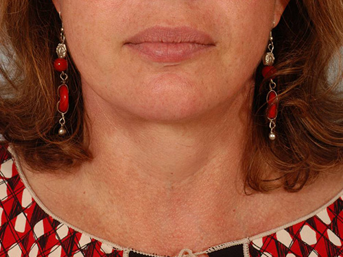 Facelift After Facelift After - Miami, FL
