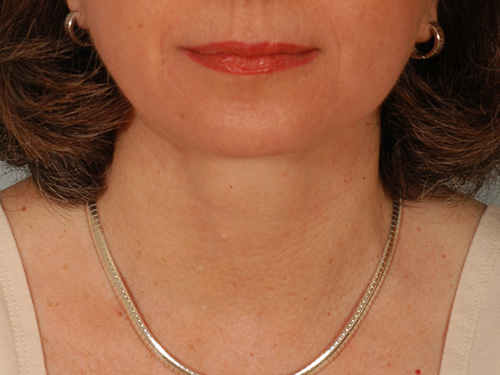 Facelift After Facelift After - Miami, FL
