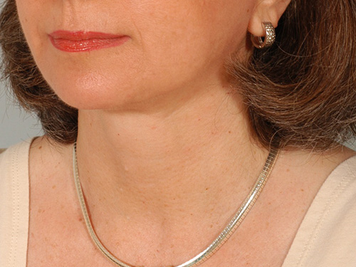 Facelift After Facelift After - Miami, FL