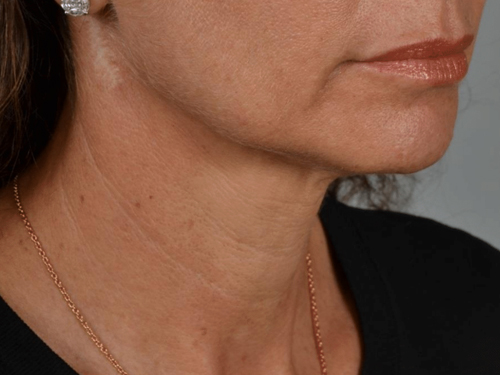 Facelift Before - Miami, FL