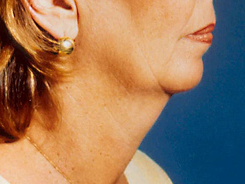 Neck Lift Before - Miami, FL