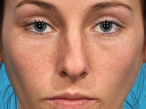 Rhinoplasty Before - Miami, FL