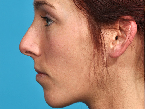 Rhinoplasty Before - Miami, FL