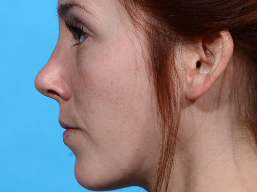 Rhinoplasty After - Miami, FL