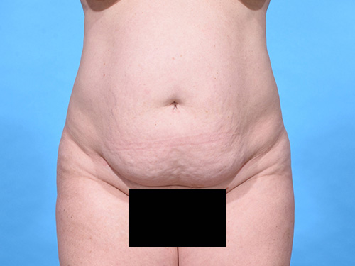 Tummy Tuck Before - Miami, FL