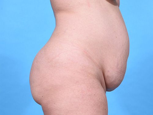 Tummy Tuck Before - Miami, FL